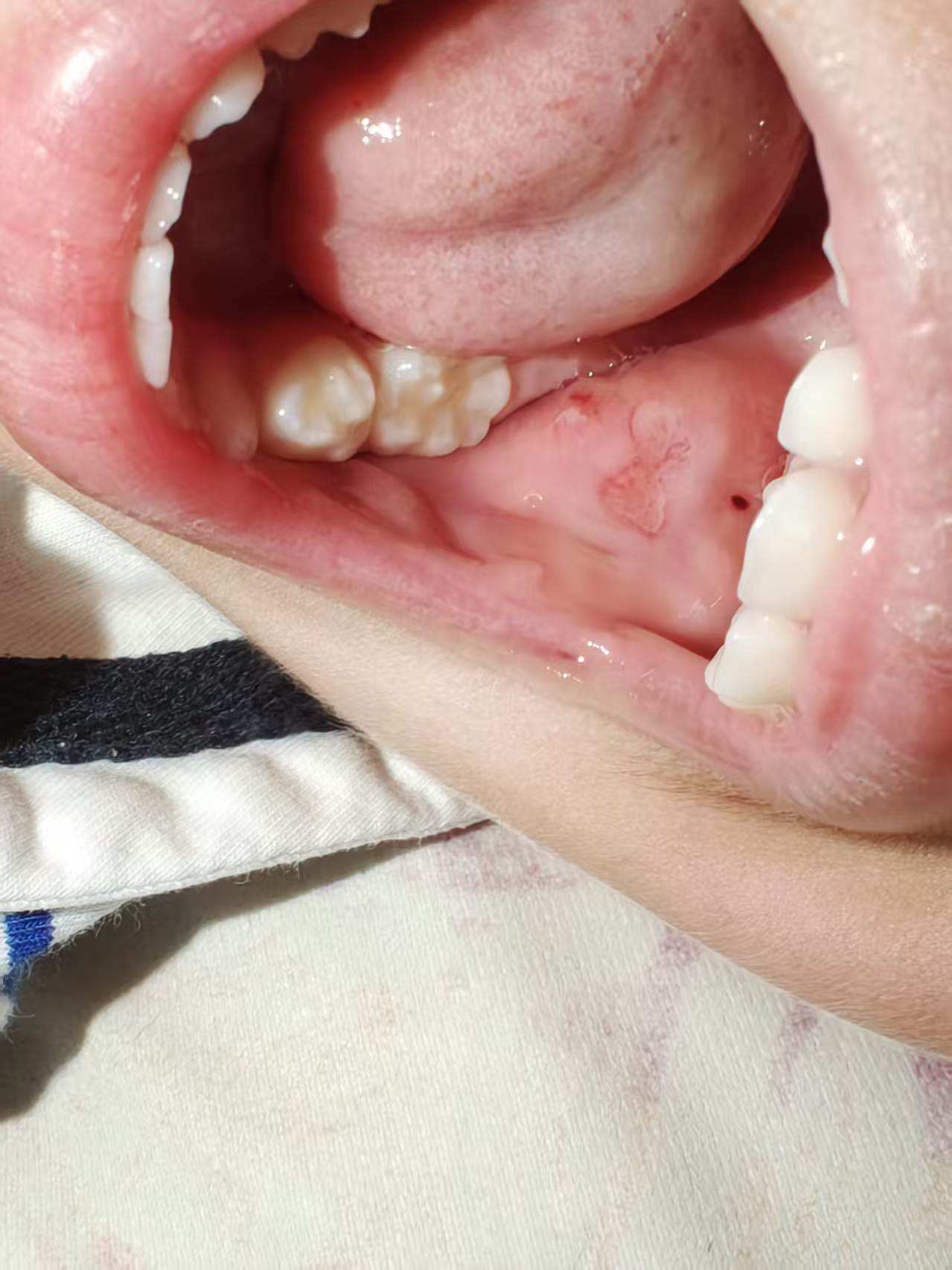 这口腔溃疡是遗传他妈的